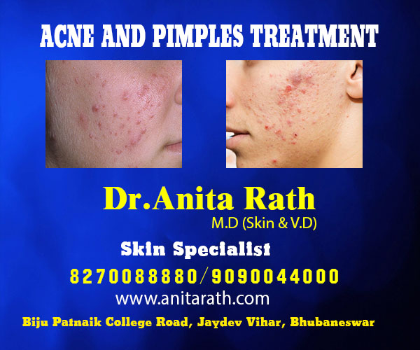 best skin specialist for acne & pimples treatment in bhubaneswar near aiims